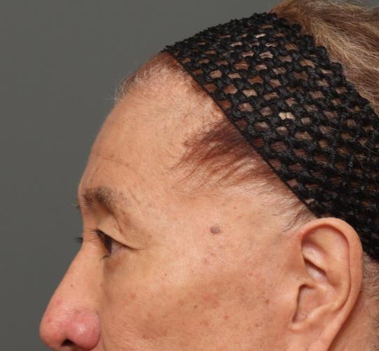 60代男性の生え際前進術 Before 症例写真