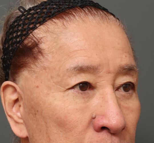 60代男性の二重整形・目元の整形 Before 症例写真