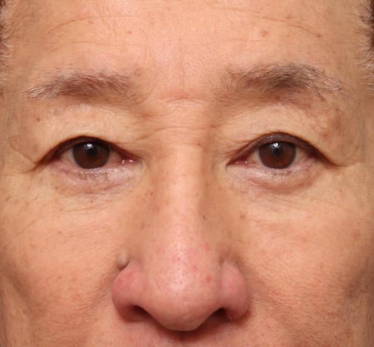 60代男性の生え際前進術 Before 症例写真