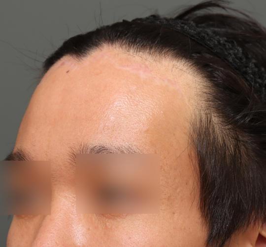 30代男性の生え際前進術 After 症例写真