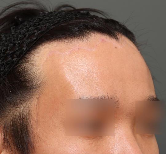 30代男性の生え際前進術 After 症例写真