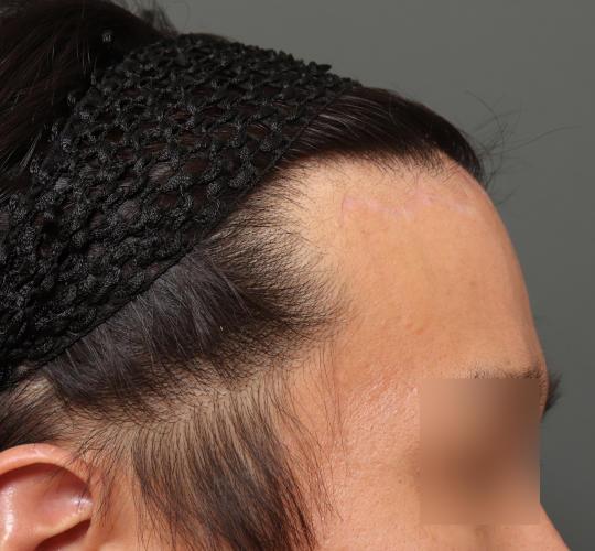 30代男性の生え際前進術 After 症例写真