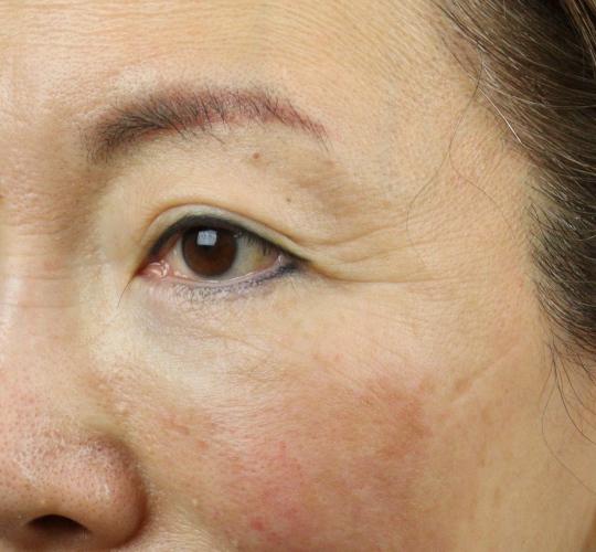 60代女性のPRP皮膚再生療法 After 症例写真