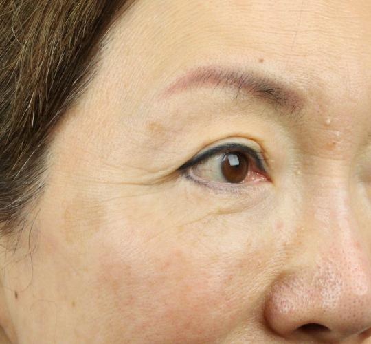 60代女性のPRP皮膚再生療法 After 症例写真