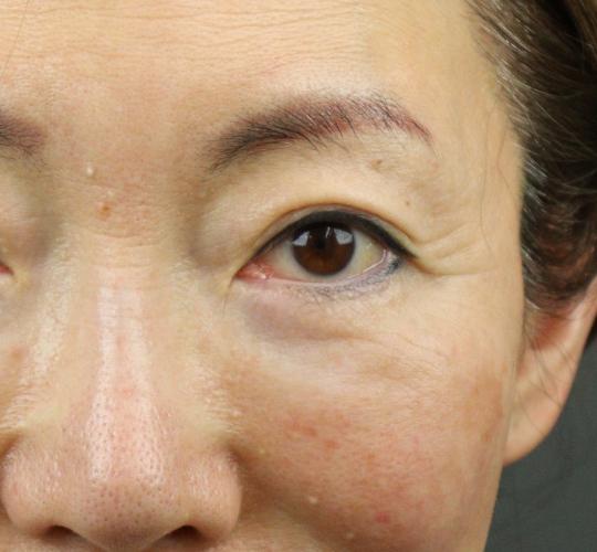 60代女性のPRP皮膚再生療法 After 症例写真