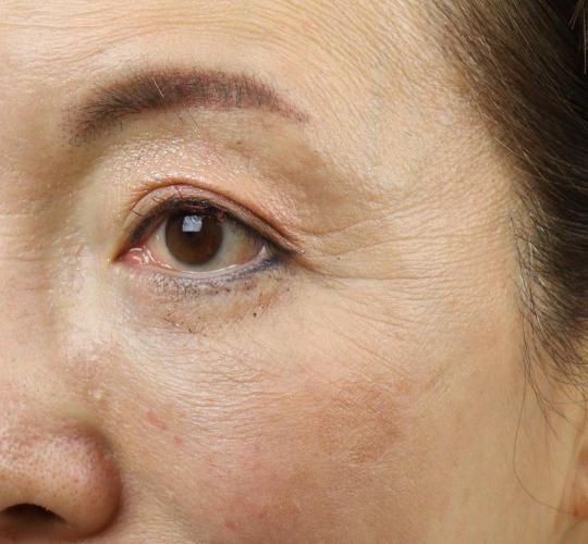 60代女性のPRP皮膚再生療法 Before 症例写真