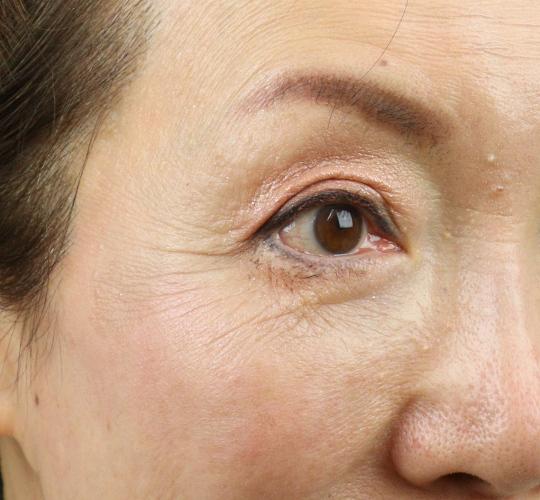 60代女性のPRP皮膚再生療法 Before 症例写真