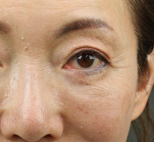 60代女性のPRP皮膚再生療法 Before 症例写真