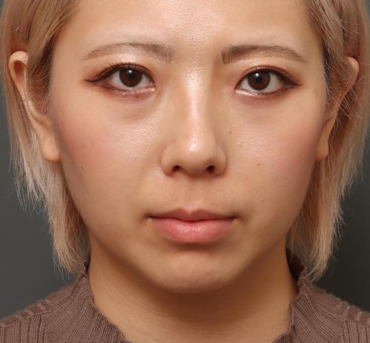 20代女性の顔の脂肪吸引  After 症例写真