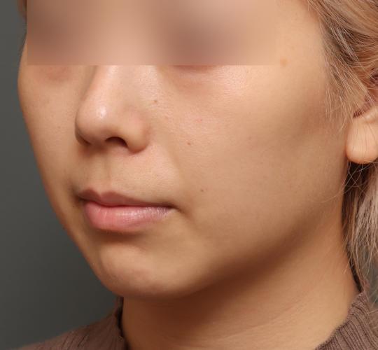 20代女性の顔の脂肪吸引  After 症例写真