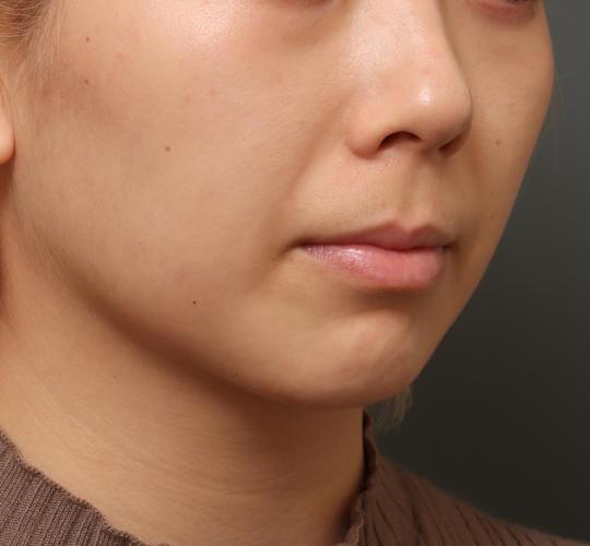 20代女性の顔の脂肪吸引  After 症例写真