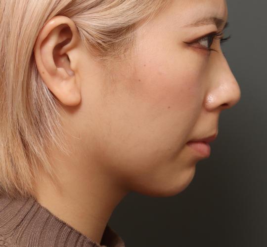 20代女性の顔の脂肪吸引  After 症例写真