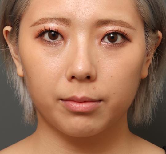 20代女性の顔の脂肪吸引  Before 症例写真