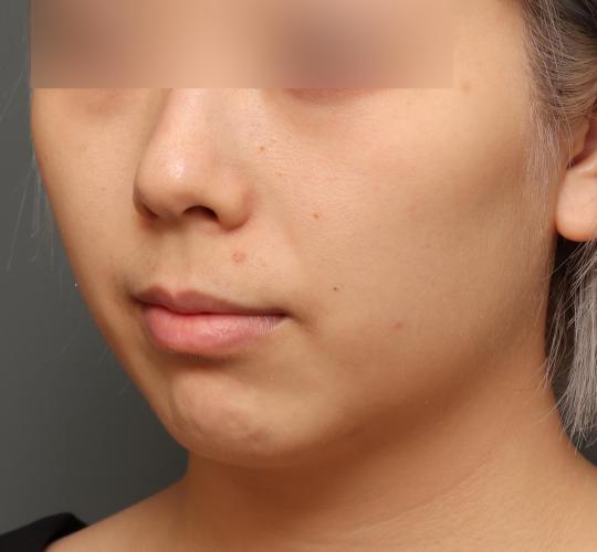 20代女性の顔の脂肪吸引  Before 症例写真