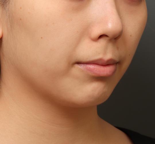 20代女性の顔の脂肪吸引  Before 症例写真