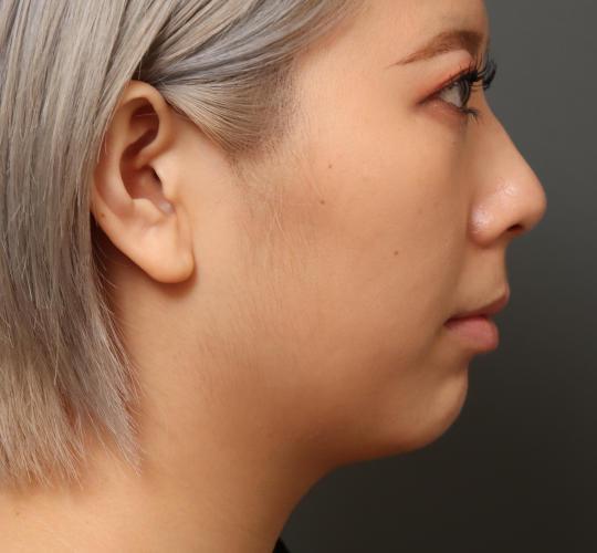 20代女性の顔の脂肪吸引  Before 症例写真