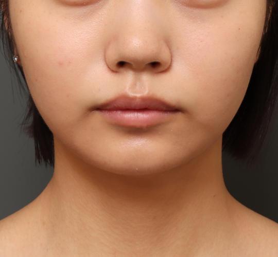 10代女性の顔の脂肪吸引  After 症例写真