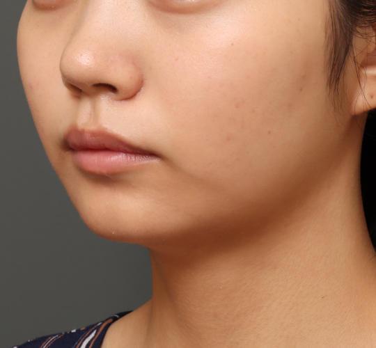 10代女性の顔の脂肪吸引  After 症例写真