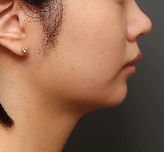 10代女性の顔の脂肪吸引 After 症例写真