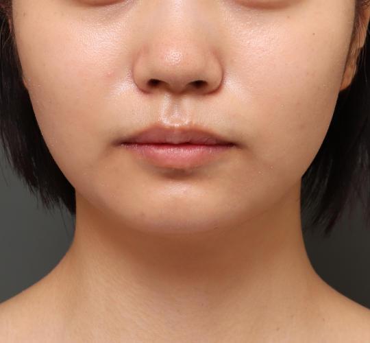 10代女性の顔の脂肪吸引  Before 症例写真