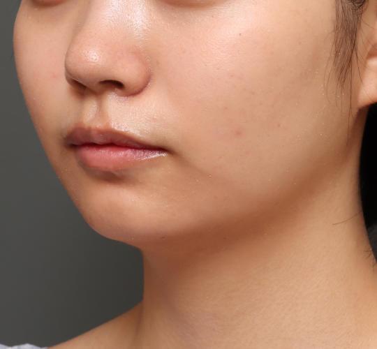 10代女性の顔の脂肪吸引  Before 症例写真