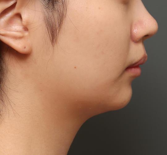 10代女性の顔の脂肪吸引 Before 症例写真