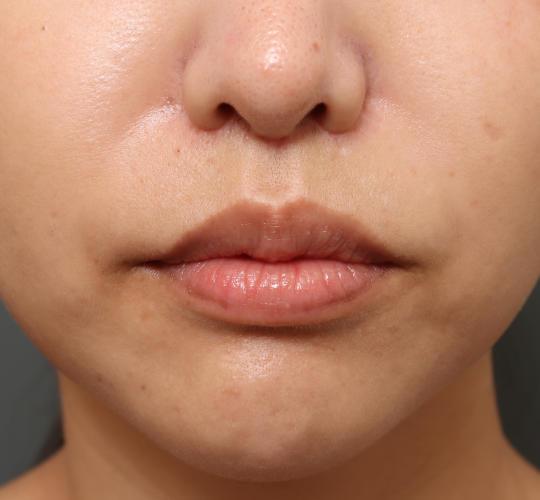 20代女性の鼻の整形 After 症例写真