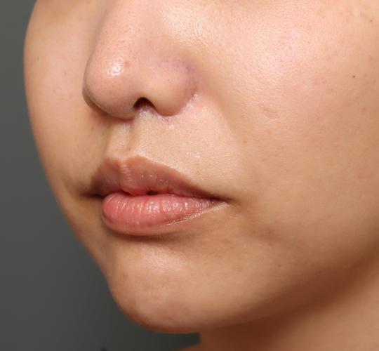 20代女性の鼻翼縮小（小鼻縮小） After 症例写真
