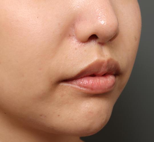 20代女性の鼻翼縮小（小鼻縮小） After 症例写真