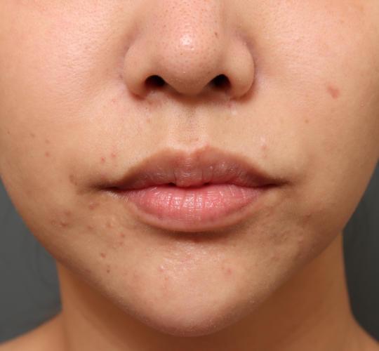 20代女性の鼻の整形 Before 症例写真