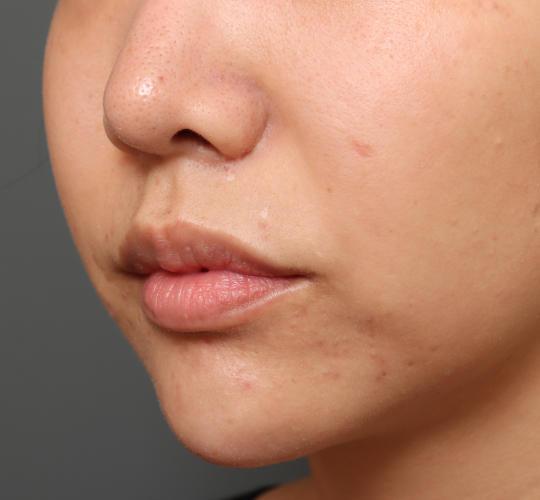 20代女性の鼻翼縮小（小鼻縮小） Before 症例写真