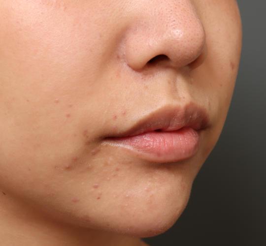 20代女性の鼻翼縮小（小鼻縮小） Before 症例写真