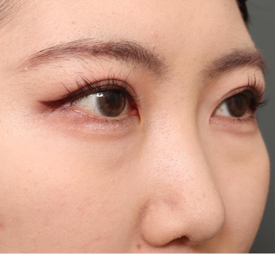 20代女性の目つき矯正 After 症例写真