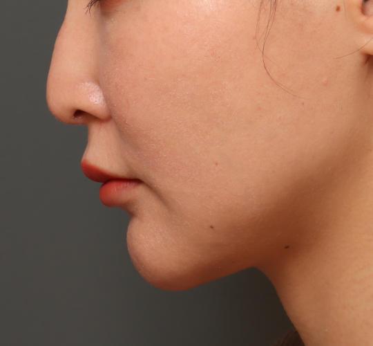 30代女性の鼻の整形 After 症例写真