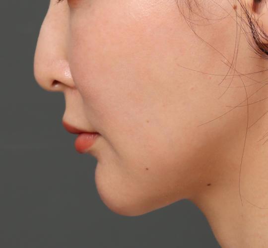 30代女性の鼻の整形 Before 症例写真