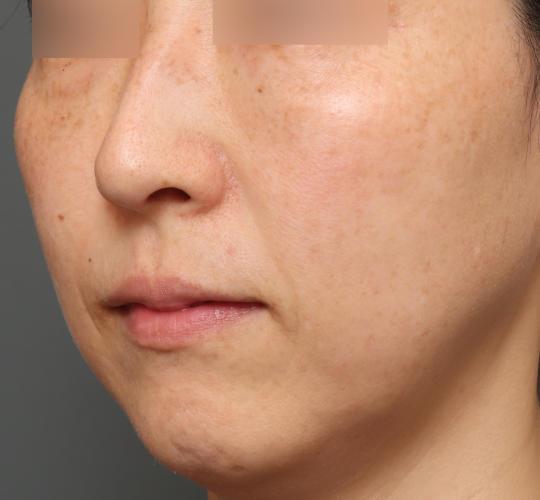 40代女性のピコシュア After 症例写真