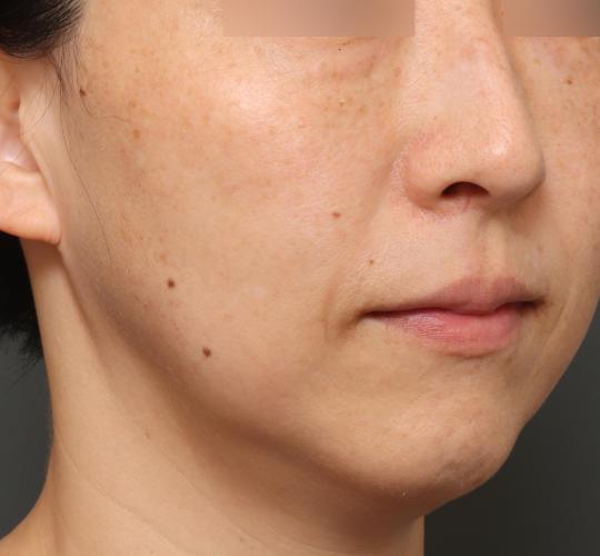 40代女性のピコシュア After 症例写真