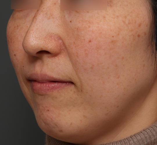 40代女性のピコシュア Before 症例写真