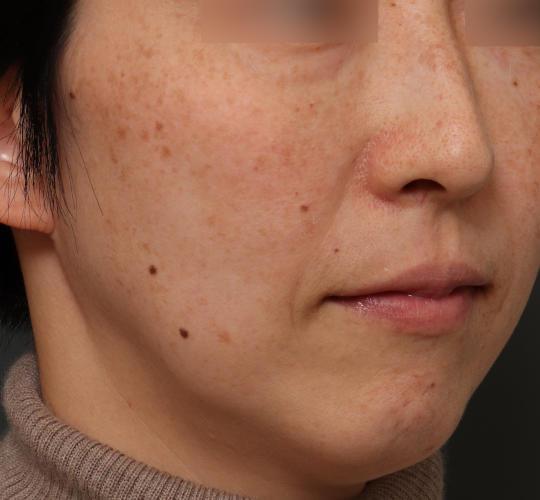 40代女性のピコシュア Before 症例写真