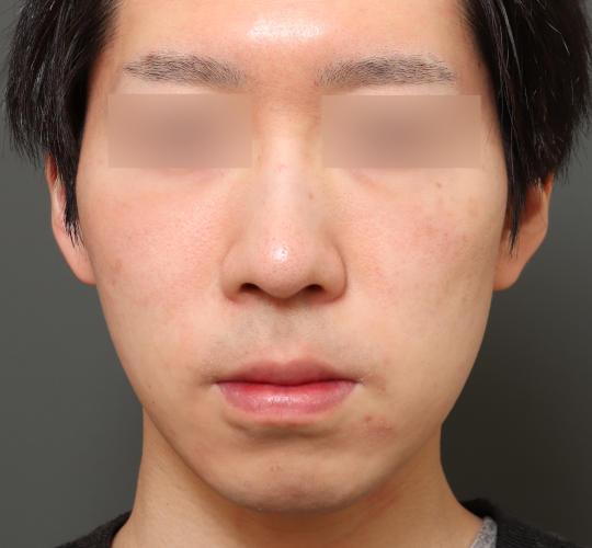 20代男性の美肌治療 After 症例写真
