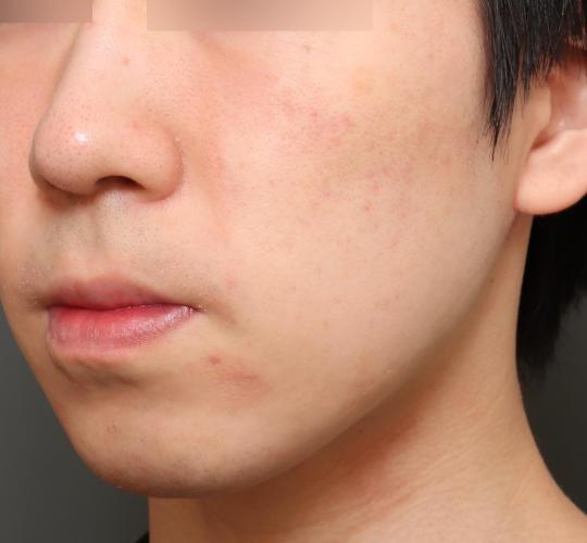 20代男性の肌管理毛穴スリークスキン（ダーマペン4） After 症例写真