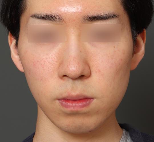 20代男性の美肌治療 Before 症例写真