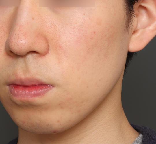 20代男性の肌管理毛穴スリークスキン（ダーマペン4） Before 症例写真