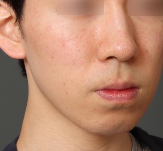 20代男性の肌管理毛穴スリークスキン（ダーマペン4） Before 症例写真