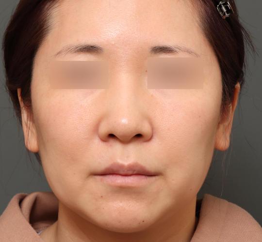 30代女性の美肌治療 After 症例写真