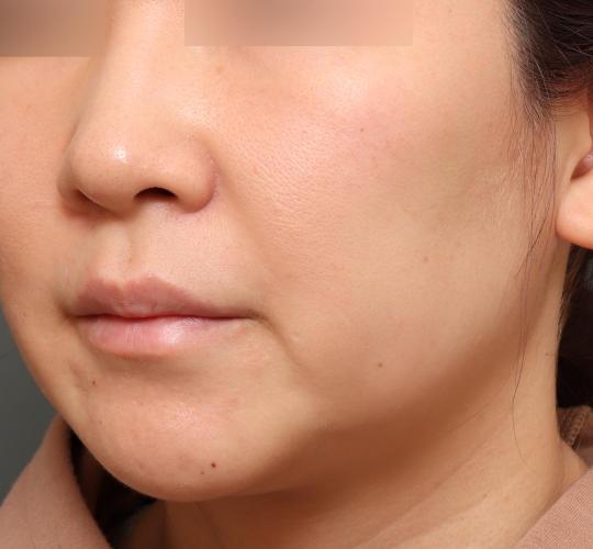 30代女性の肌管理毛穴スリークスキン（ダーマペン4） After 症例写真