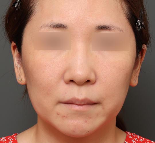 30代女性の美肌治療 Before 症例写真