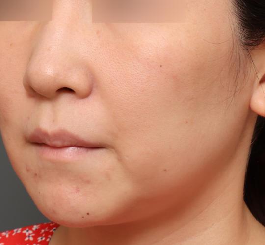 30代女性の肌管理毛穴スリークスキン（ダーマペン4） Before 症例写真