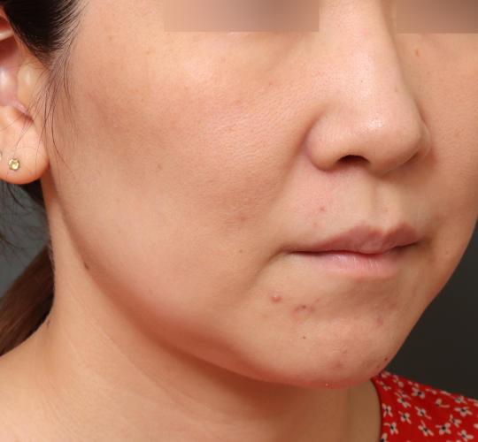 30代女性の肌管理毛穴スリークスキン（ダーマペン4） Before 症例写真