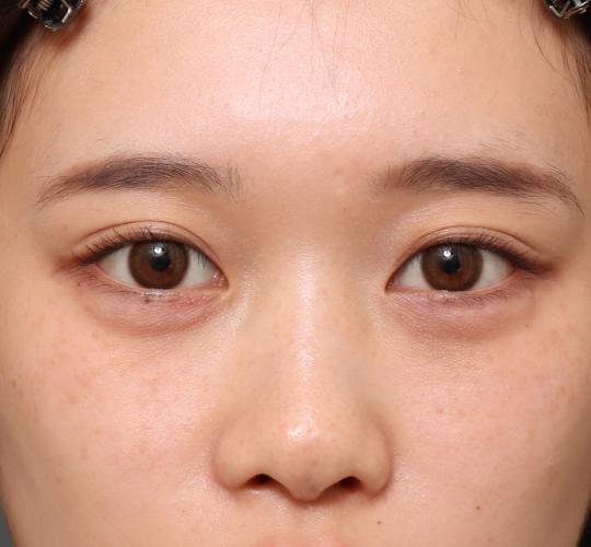 10代女性のヒアルロン酸注射（涙袋） After 症例写真